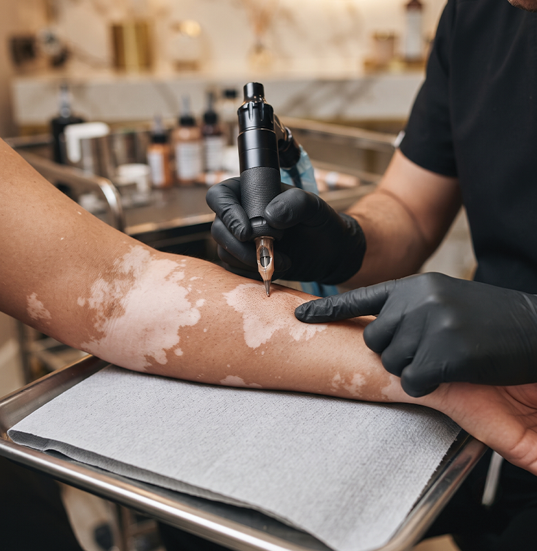 Vitiligo Tattoo Near Me Mission