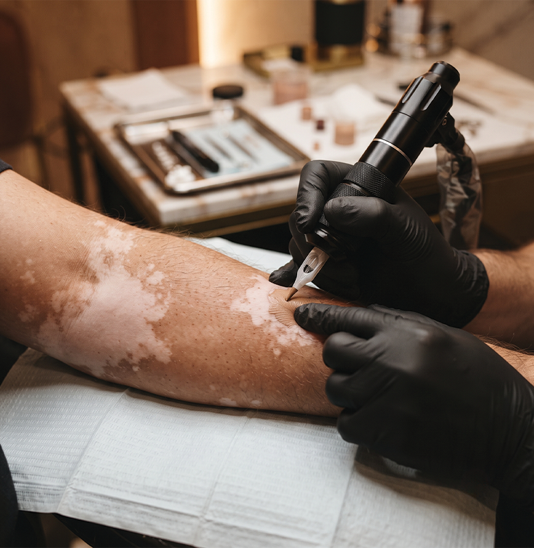 Best Vitiligo Tattoo Abbotsford